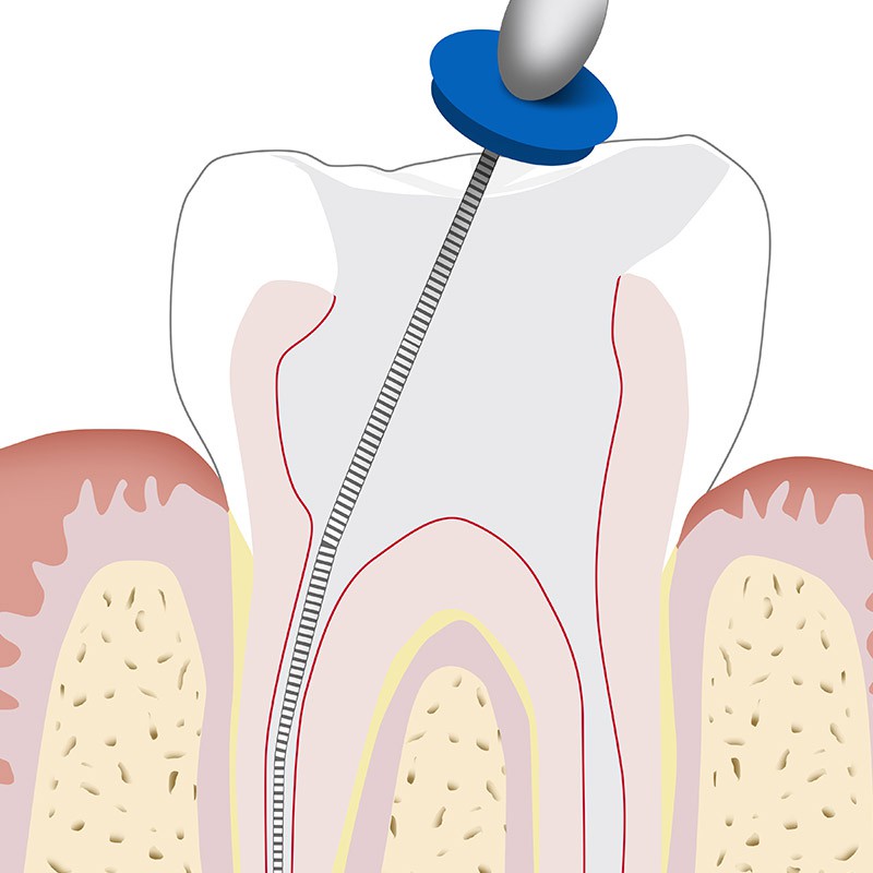 Endodonzia in microscopia